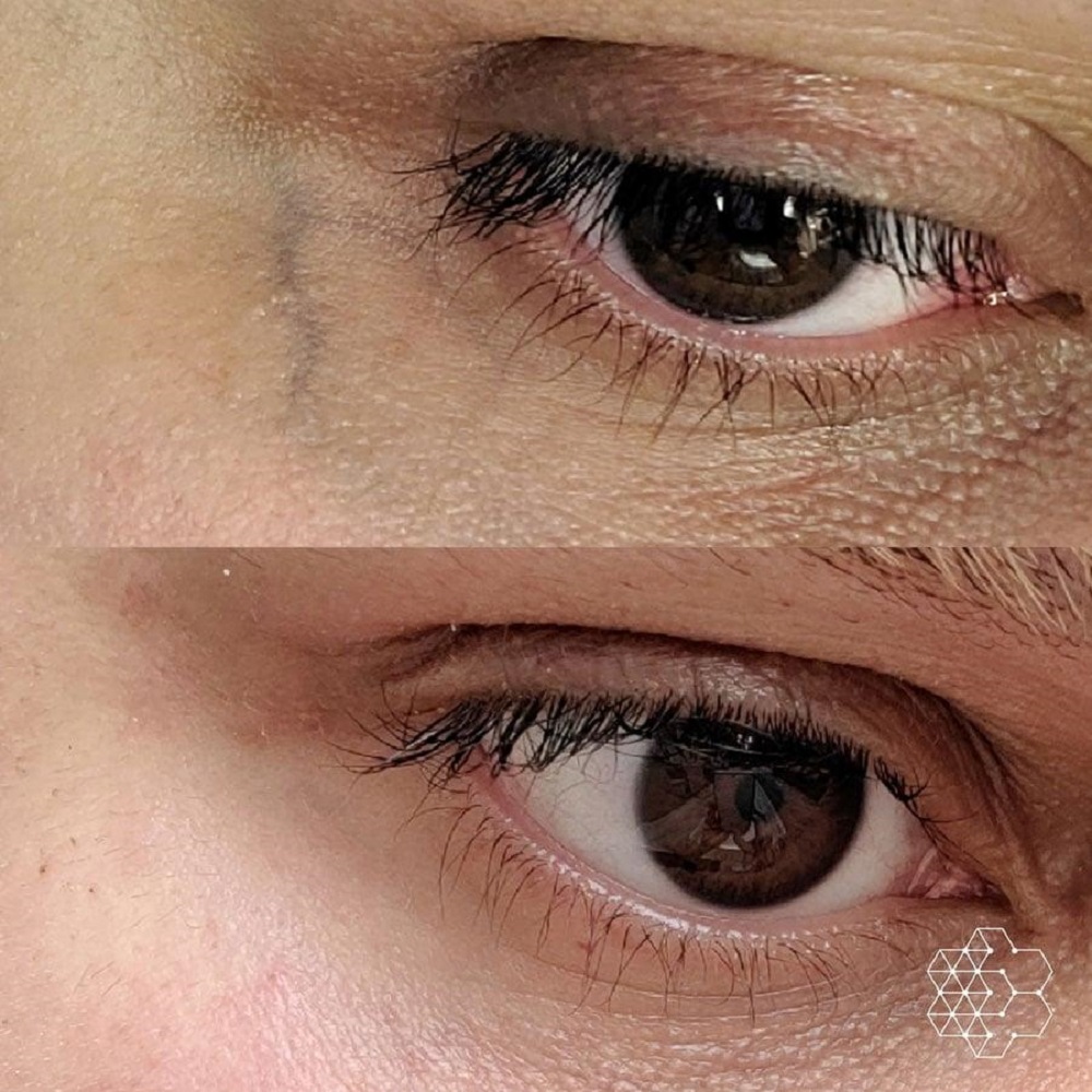 prf under eyes