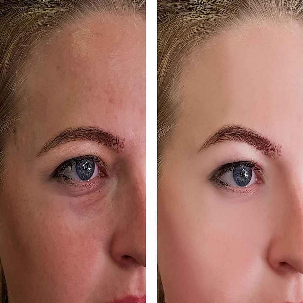 prf under eyes